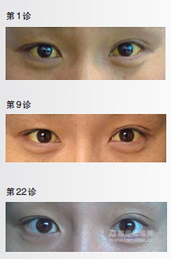 "殊途同归"的中,西医诊治药物性肝损害